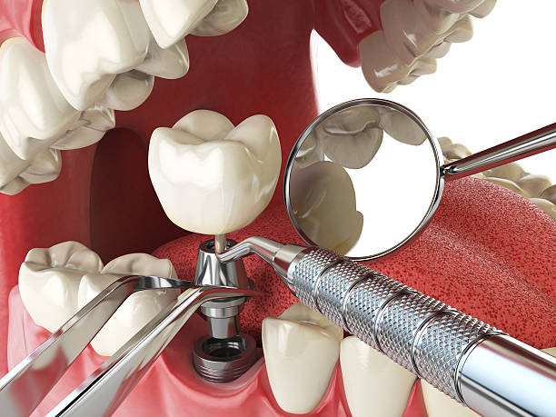 Best Emergency Broken Tooth Repair in Stephens City, VA